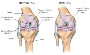 Lesione del LCA – Legamento Crociato Anteriore del Ginocchio