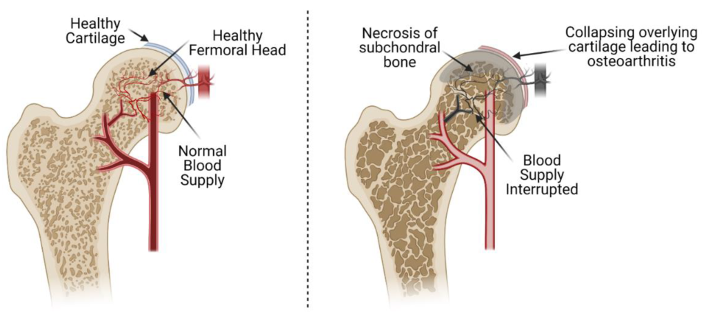 Necrosi avascolare (osteonecrosi)